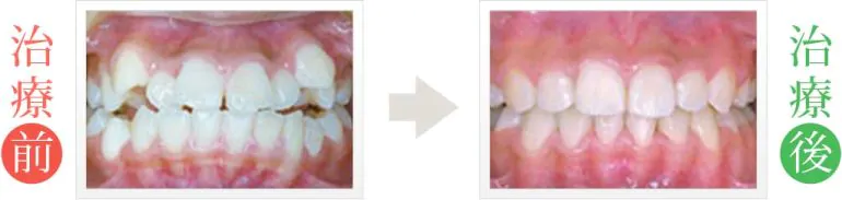 歯のデコボコ＆八重歯の矯正歯科治療