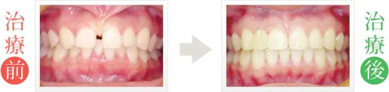 なかの歯科・矯正歯科クリニック（岡山）の治療症例：前歯の隙間