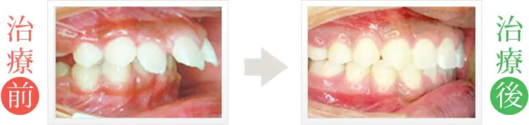 重度の上顎前突の矯正歯科治療