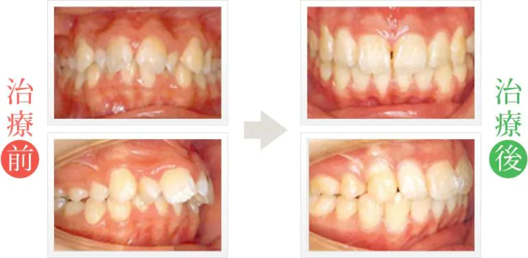 出っ歯の矯正歯科治療（正面・側面）