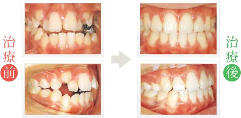 歯並びの悪さを歯列矯正治療