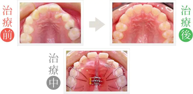 永久歯の生える隙間を作る小児矯正治療