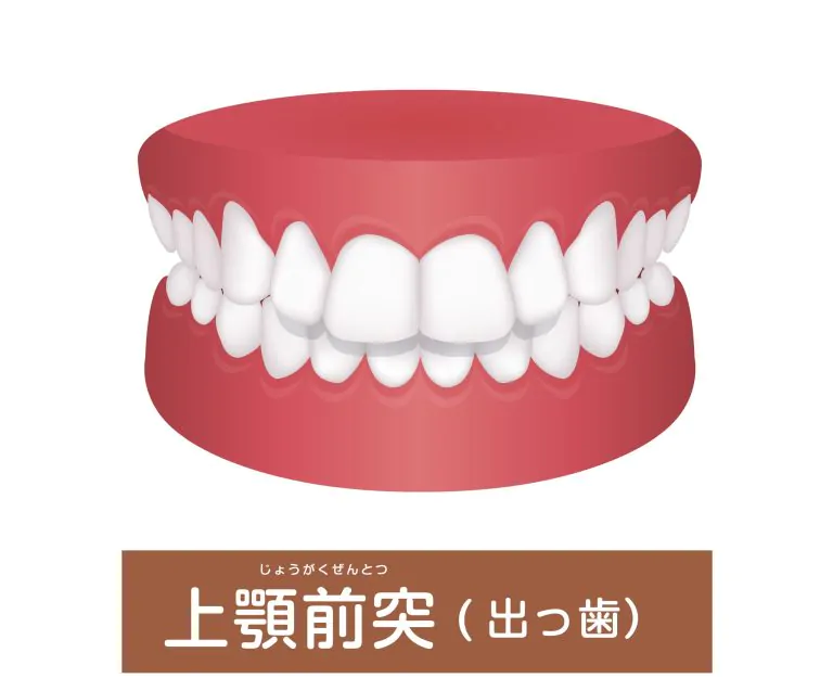 出っ歯（口ゴボ）は矯正歯科治療で歯並びキレイに