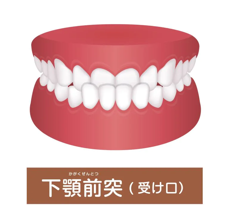 受け口（下顎前突）は矯正歯科治療で歯並びキレイに