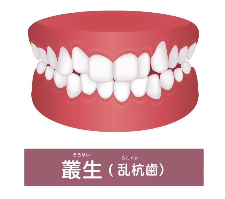 叢生（歯がデコボコ・八重歯）は矯正歯科治療で歯並びキレイに