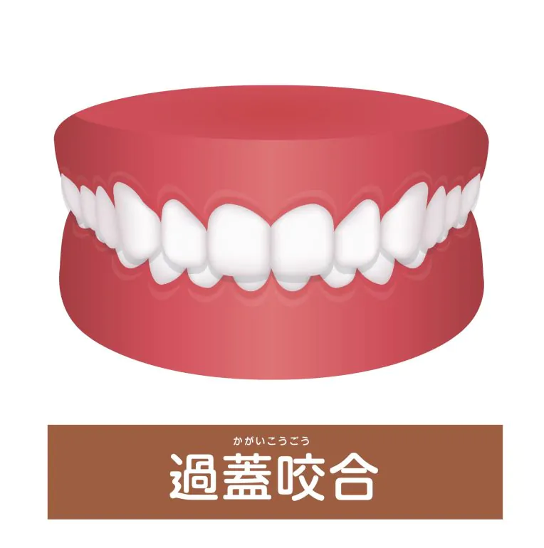 過蓋咬合（嚙み合わせが深い）は矯正歯科治療で歯並びキレイに