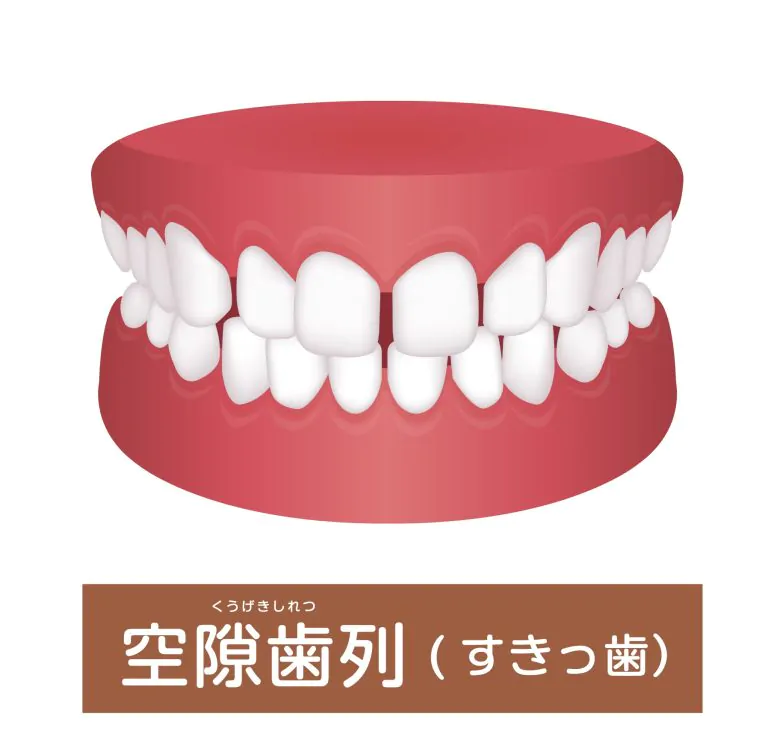 すきっ歯（空隙歯列）は矯正歯科治療で歯並びキレイに