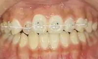 固定式の矯正歯科治療装置